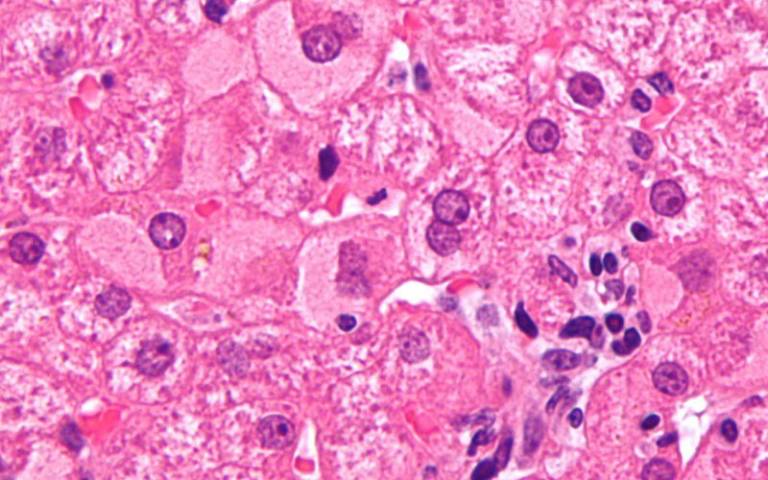 High magnification micrograph of ground glass hepatocytes