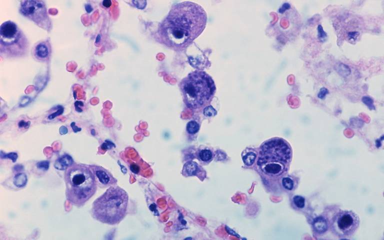 Cytomegalovirus infection by Yale Rosen via Flickr (Cropped)