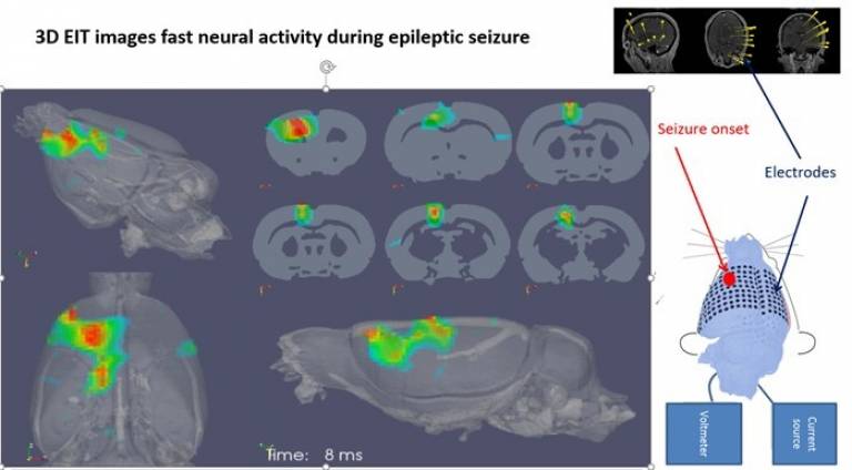 3D E.I.T. images fast neural activity during epileptic seizure