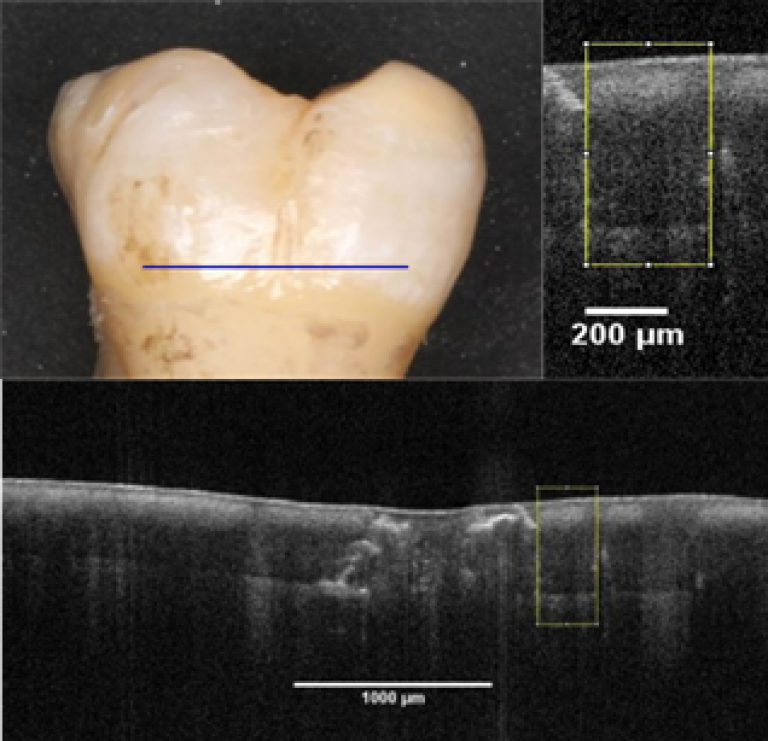 Picture of tooth and imaging of the tooth