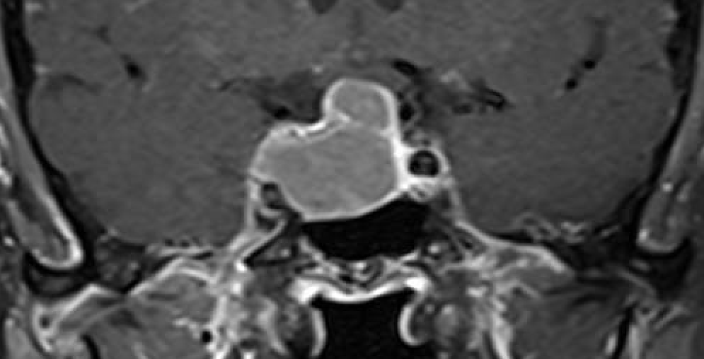 MRI pituitary