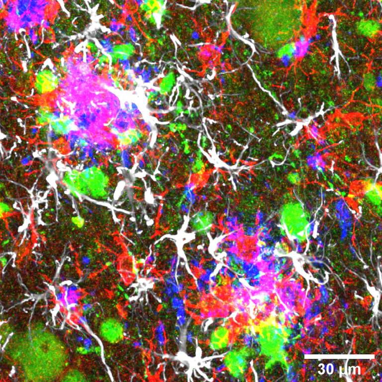 Alzheimer neurons