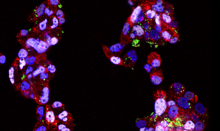 Brain tumour stem cells in tissue culture