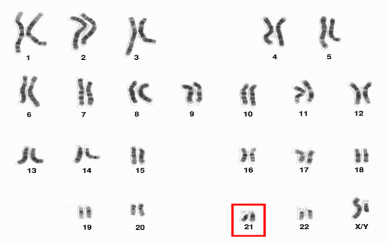 Human male karotype with chromosome 21 highlighted