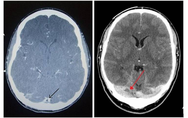 Left: CT venogram showing a filling defect in the sagittal sinus (black arrow). Right: A dural venous sinus thrombosis of the transverse sinus. Greater on the right than left.