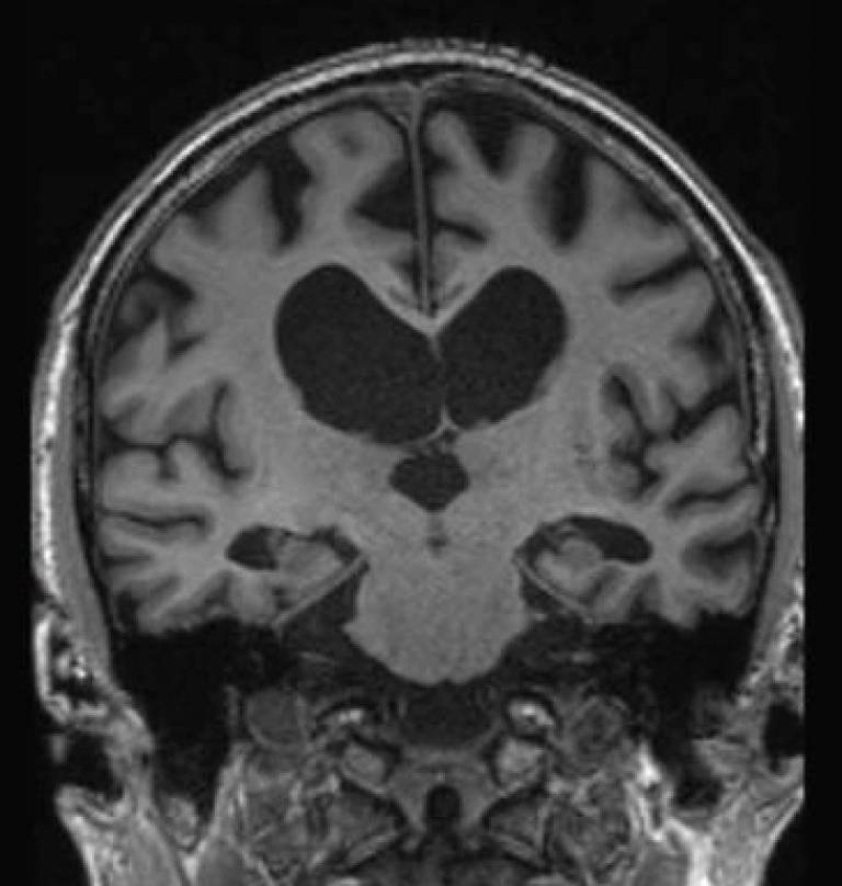 MRI atrophy