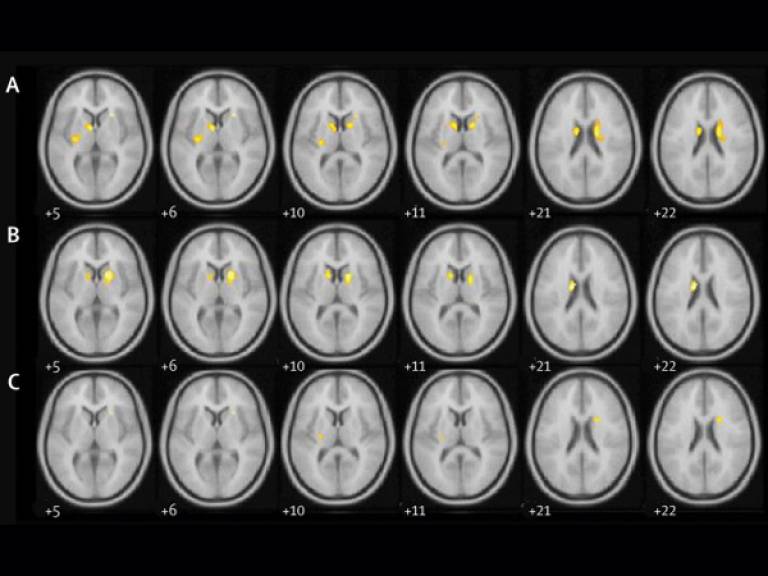 parkinsons brains DAT scans exenatide clinical trial