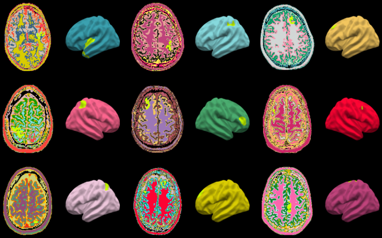 Brain abnormalities identified by the MELD AI algorithm (highlighted in lime green) on MRI scans of children and adults with epilepsy from around the world 