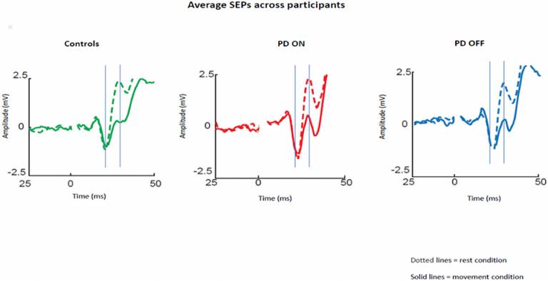 sensory attenuation in parkinson's disease: figure from Macerollo et al 2019