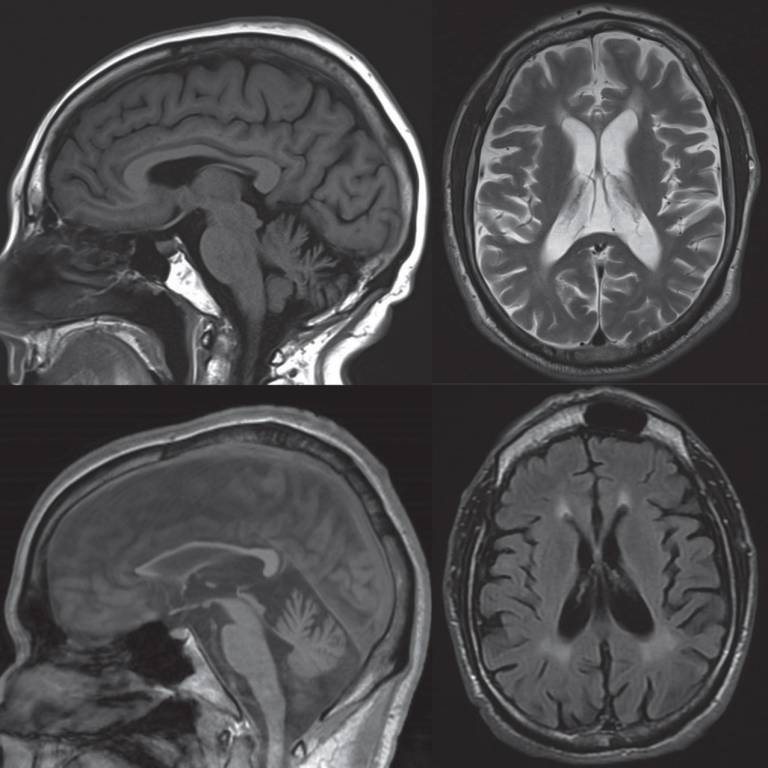 Brain imaging in patients with HSP: image from Shribman et al 2019