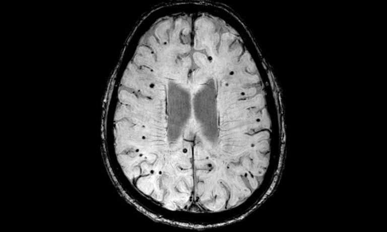 stroke MRI