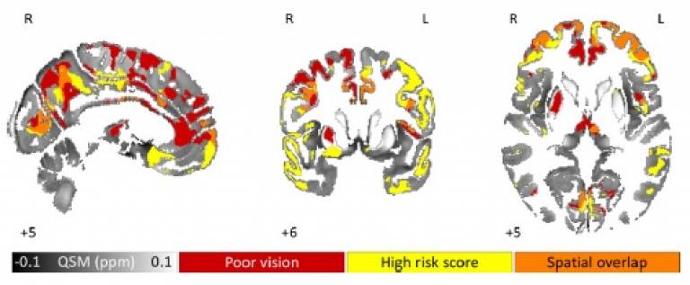 Figure 4 from Brain Iron Deposition in Parkinson's dementia article_Thomas et al Feb 2020 JNNP
