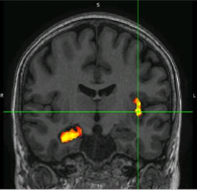 MRI scan in epilepsy