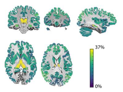 Brain areas with the strongest link between grey matter loss and risk of disability accumulation, with the thalamus shown in yellow