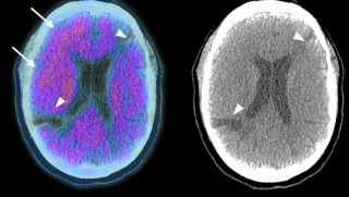 Amyloid PET scans of iatrogenic cerebral amyloid angiopathy (CAA)