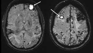 Susceptibility-weighted MRI of iatrogenic cerebral amyloid angiopathy (CAA)
