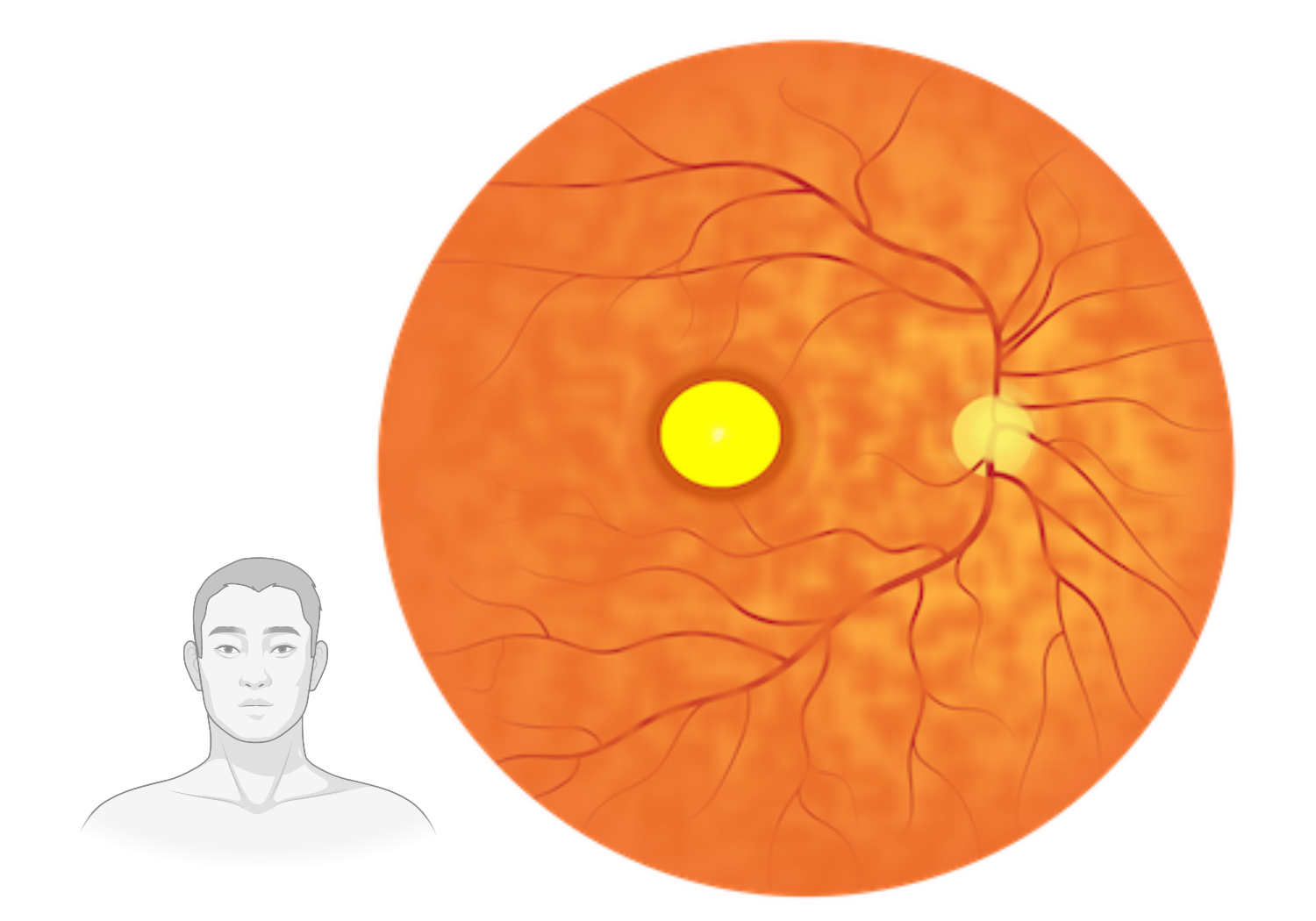 Fundus image of a retina suffering from AVMD. Visible 'egg-yolk' formation.