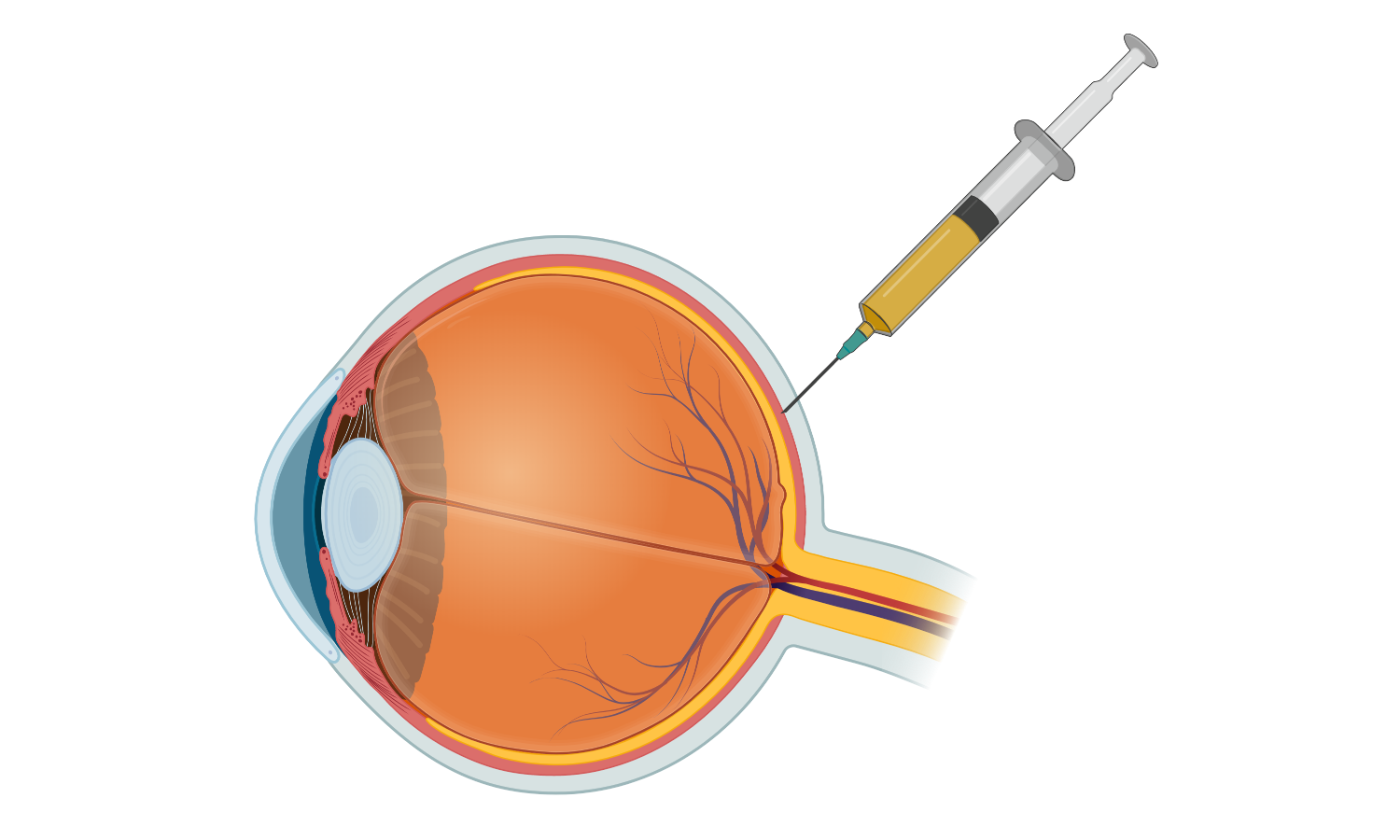 Schematic of an eye being injected
