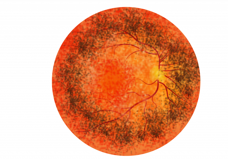 Schematic of the fundus image of a retina suffering from ADVIRC. A highly pigmented circular band present in the outer regions (periphery) of the retina, with a distinct border between the highly pigmented retina and normal retina.