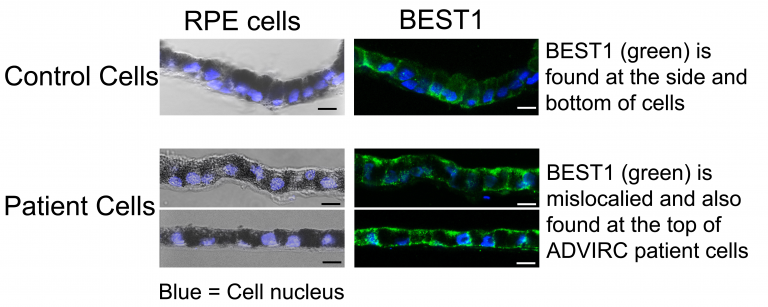 Image of RPE cells labeled for BEST1 protein (green). Top = healthy RPE cells. Bottom = Patient diseased RPE cells.