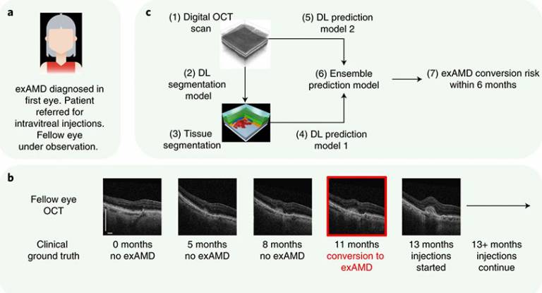 Clinical set up and proposed system for predicting conversion to wet age-related macular degeneration using deep learning