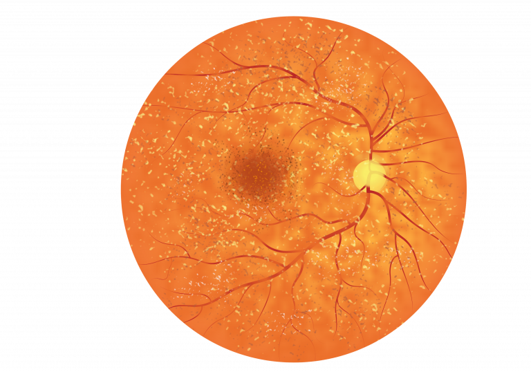Fundus image of a retina suffering from Autosomal Recessive Bestrophinopathy. Fundus appears speckled, with irregularities of the RPE cells and the presence of yellow/white dots or flecks scattered across the retina.