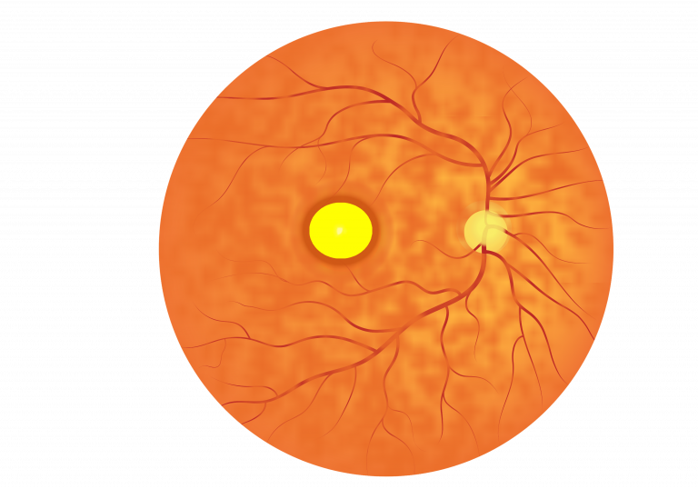 Schematic of the fundus image of a retina suffering from Best disease. In the centre of the fundus there is the characteristic 'egg-yolk' lesion associated with Best disease.