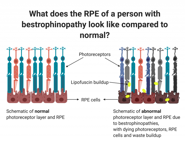Left: healthy RPE and Photoreceptor layer. Right: Schematic of degrading RPE and dying photoreceptors with a buildup of lipofuscin (waste)
