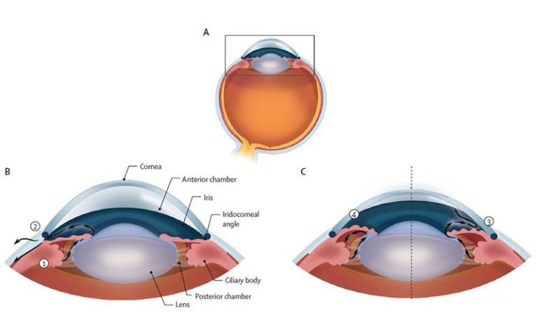 Determination of intraocular pressure and differentiation between open angle and angle closure glaucoma.  