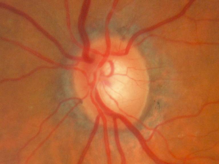 Optic nerve with glaucoma