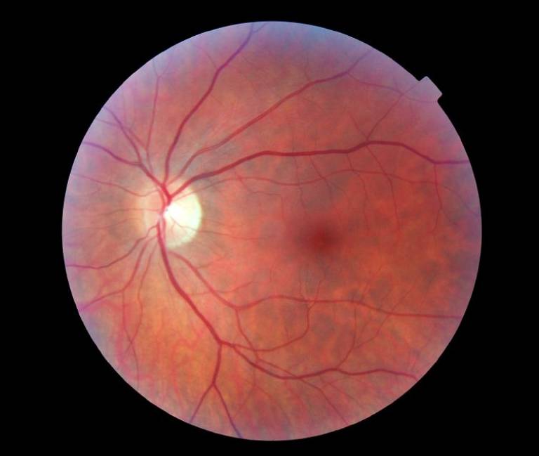 A healthy retina…