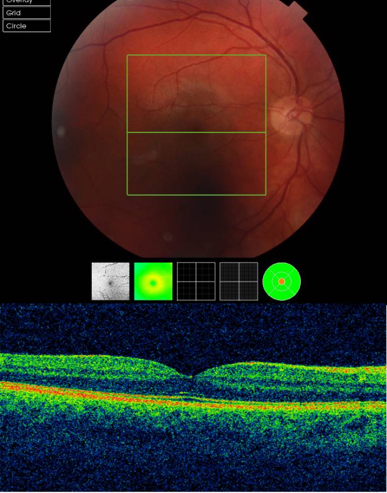 Normal retina image and OCT…