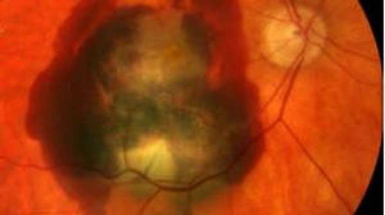 New Trial for Wet AMD…