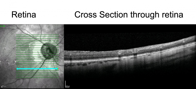 OCT image of a patient's retina.