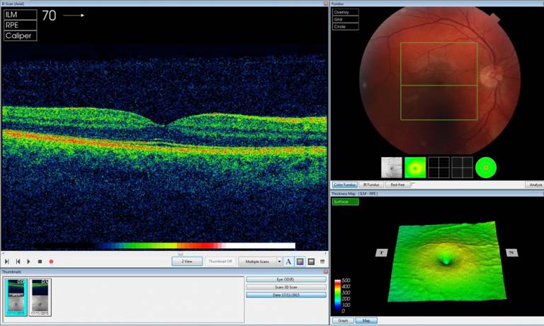 Analysing an OCT scan of the right eye (Credit: Moorfields Eye Hospital)