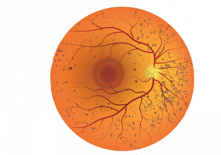 Fundus image of a retina suffering from Retinitis Pigmentosa. Peripheral retina pigment deposits can be seen and a swelling macular