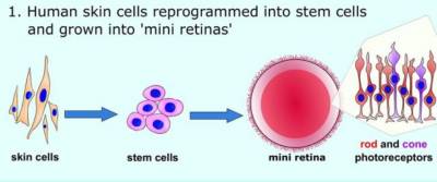 New gene therapy approach may offer a new treatment for retinitis pigmentosa (RP)