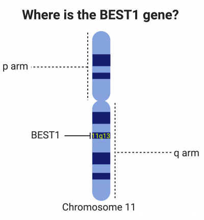 Schematic of a chromosome showing BEST1 located at the 11q13 position.