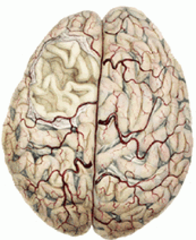 Atropy of the Brain, lithograph, 1838