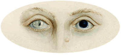 Disease of the Iris, watercolour no. D409