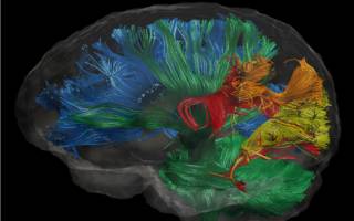 brain with areas in different colours