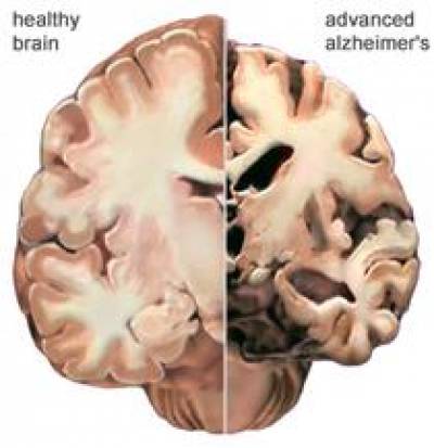 Normal and Alzheimer Brain