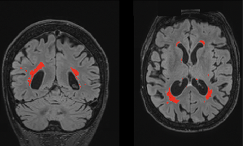 White matter of a brain highlighted in red