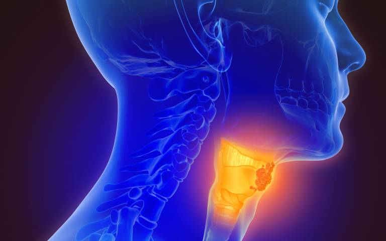 3D illustration of throat cancer showing a human head and highlighting a tumour on their esophagus 