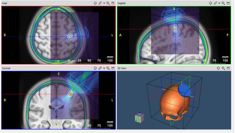 Screenshot of transcranial ultrasound stimulation modelling