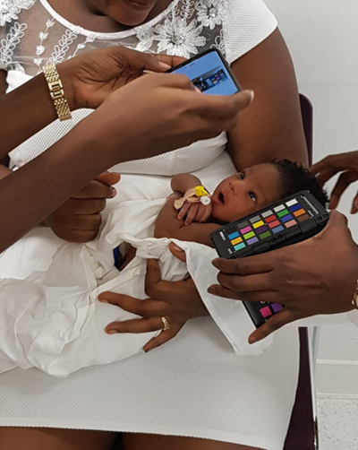 Baby in Ghana is checked for jaundice using a smartphone that takes a photo of the child's eye and analyses it