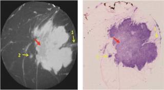 Histopathology image of a breast cancer tumour