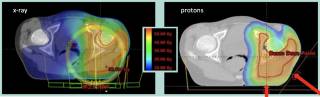 treatment plans (craniospinal and ewing sarcoma) highlighting an x-ray vs proton comparison