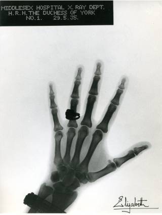 X-ray of Queen Mother's hand