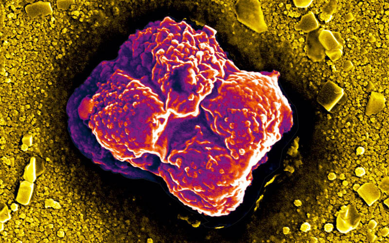  Magnified image of a breast cancer cell